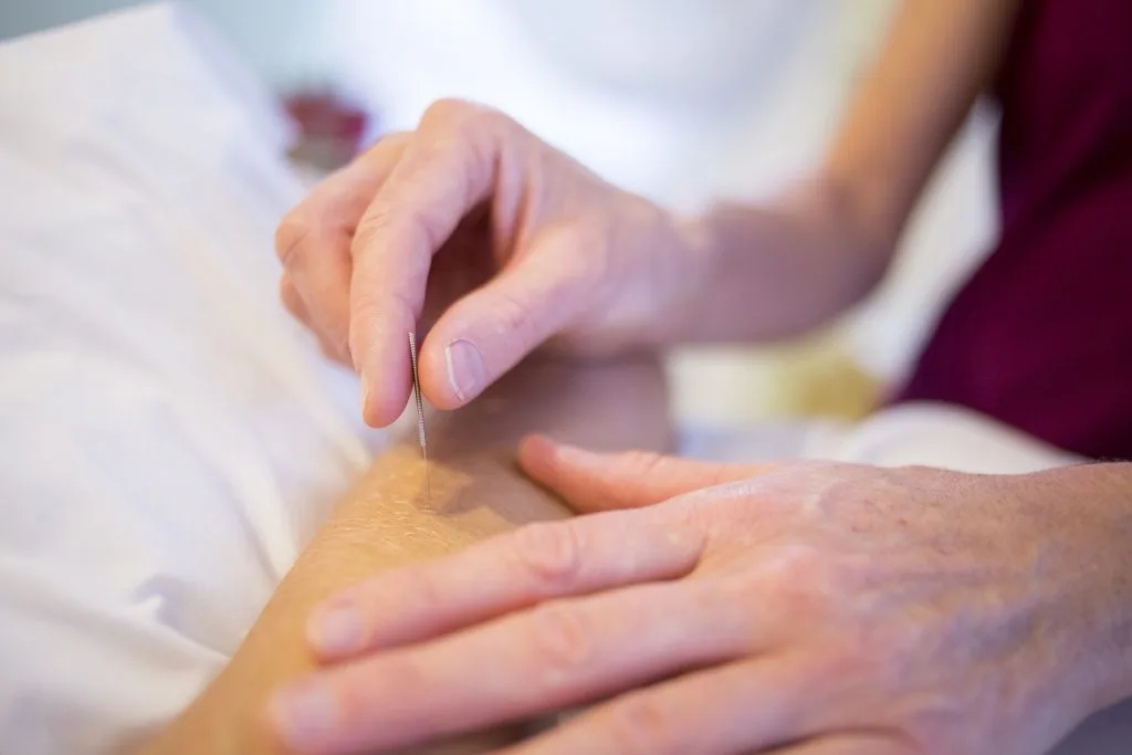 La acupuntura como terapia natural